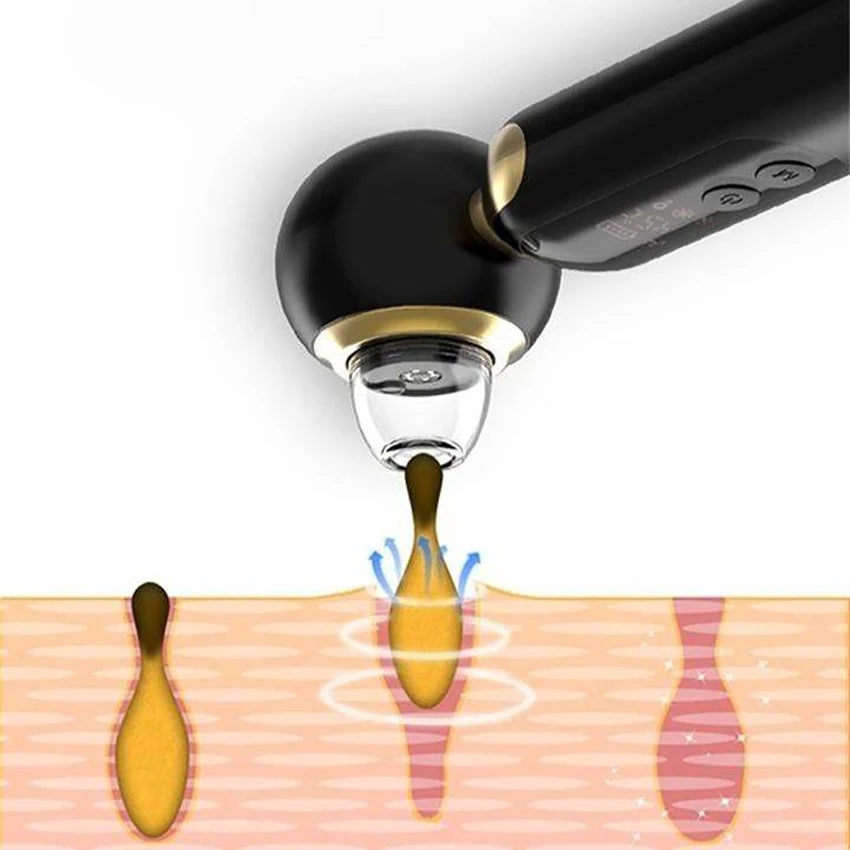 Visible Vacuum Blackhead Remover Black Head Pimples Removal Device Deep Pore Clean with Hot and Cold Compress